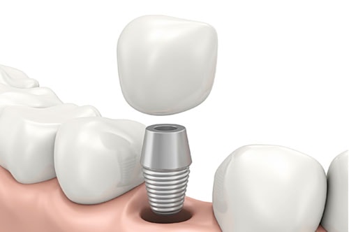 Dental Implants 1 Advanced Dental Center Of Florence, Sc | Dr. Joseph Griffin