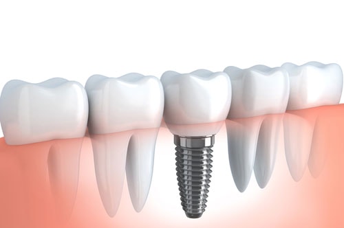 Dental Implants 2 Advanced Dental Center Of Florence, Sc | Dr. Joseph Griffin